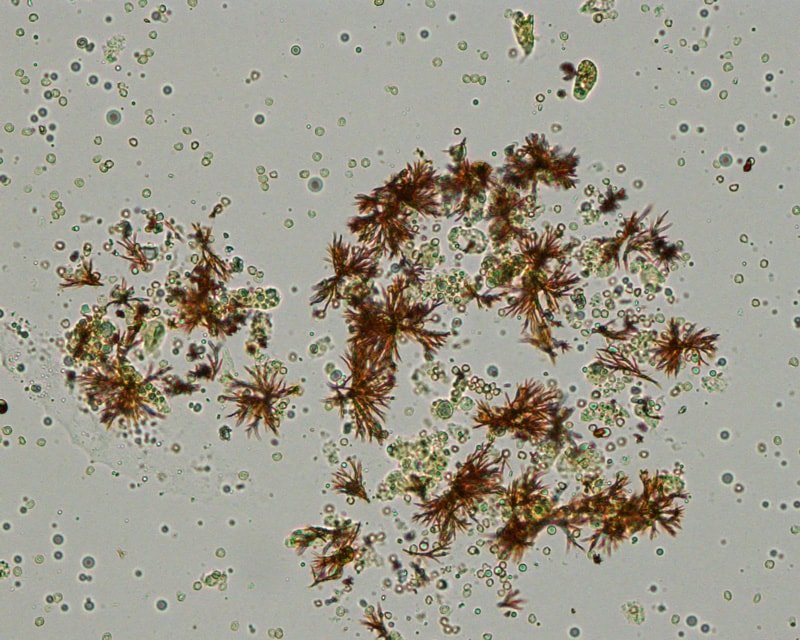 radiographic dye crystals in urine