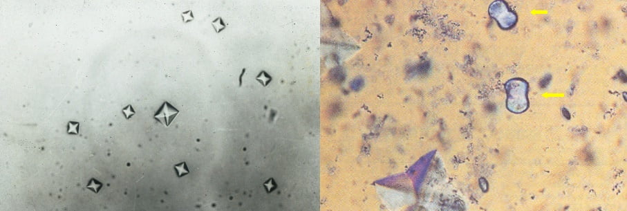 bilirubin crystals in urine