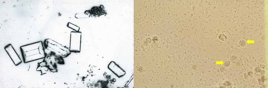 calcium phosphate crystals in urine sediment