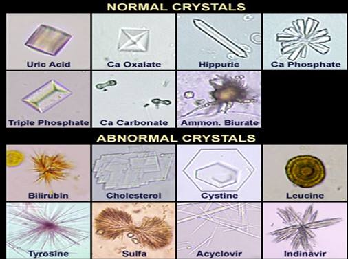 uric acid crystals in urine