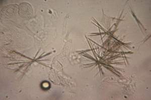 radiographic dye crystals in urine