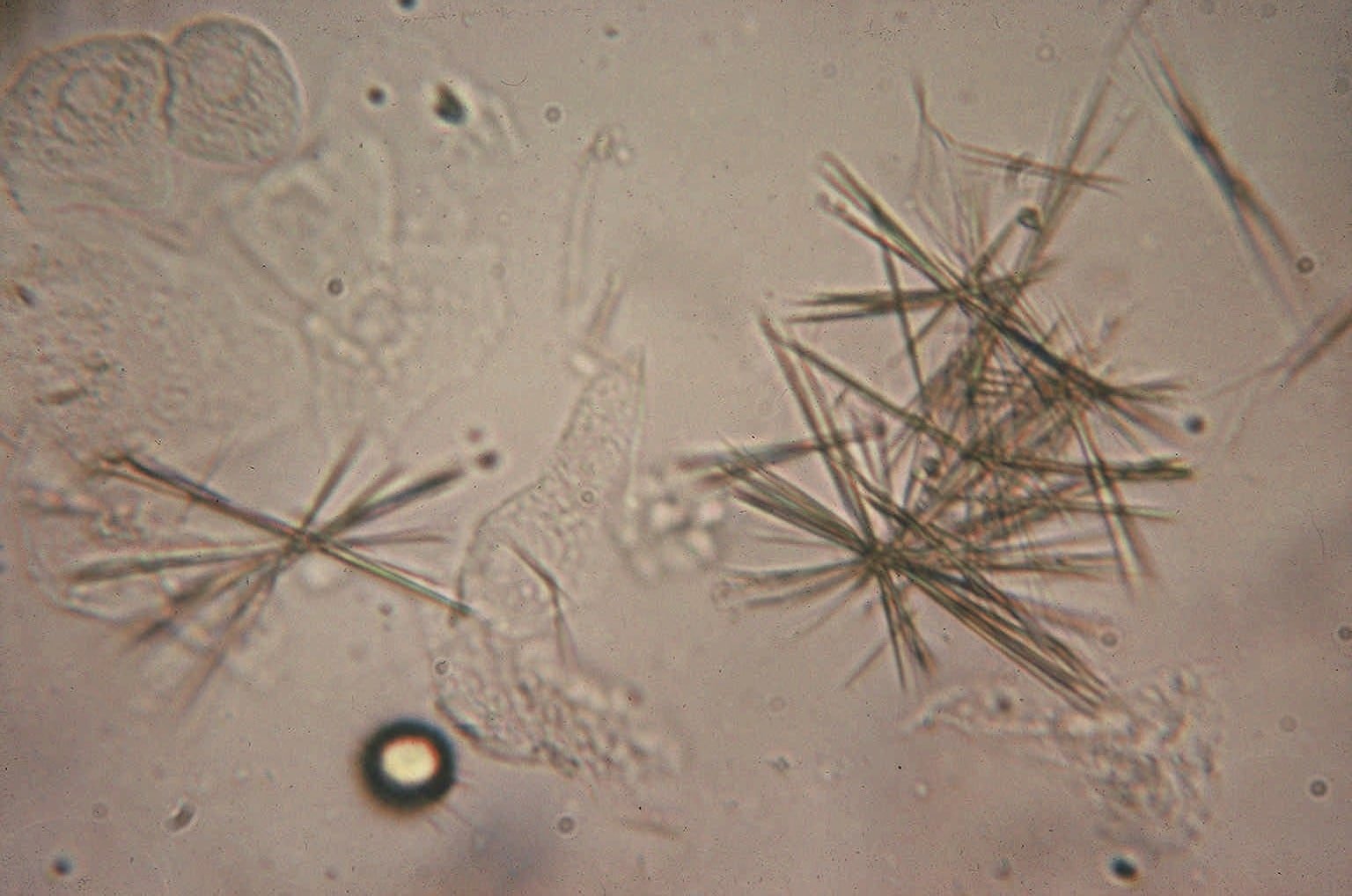Types Of Crystals In Urine Laboratory Insider 6020