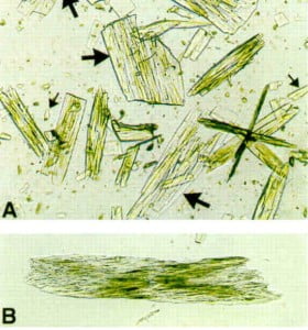 triple phosphate crystals in human urine