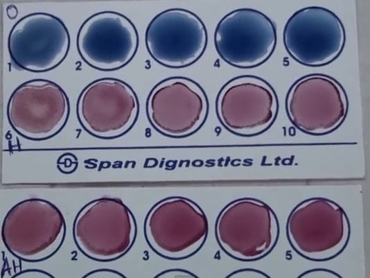 Interpretation of Widal Test- Slide Method