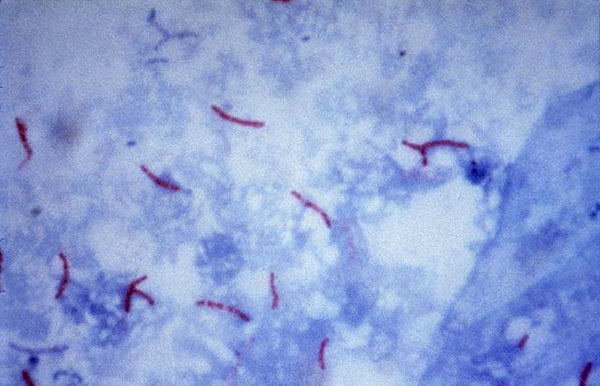 Mycobacterium tuberculosis visualization using the Ziehl–Neelsen stain