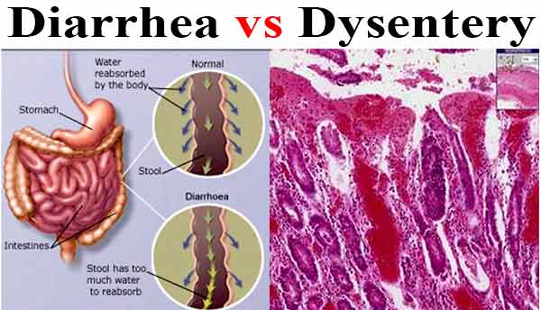 Differences Between Diarrhea And Dysentery