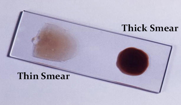 Differences Between Thick Blood Smear and Thin Blood Smear