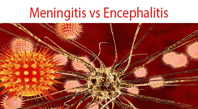 Difference Between Meningitis and Encephalitis