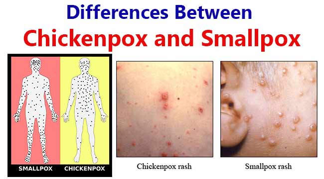 differences-between-chickenpox-and-smallpox