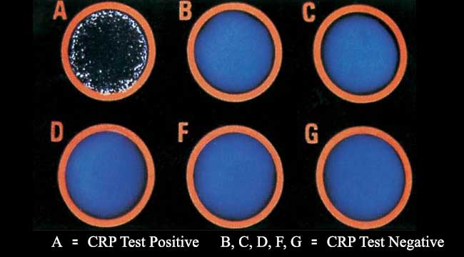 C-Reactive Protein (CRP) Test- Uses, Procedure and Result Interpretation