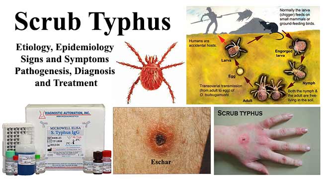 Scrub Typhus- Etiology, Epidemiology, Symptoms, Pathogenesis, Diagnosis and Treatment