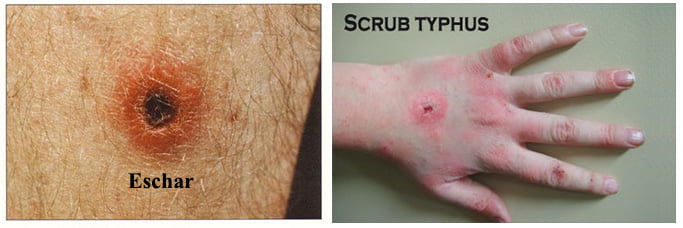 Sign and Symptoms of Scrub Typhus