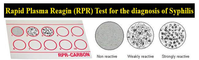 Rapid Plasma Reagin RPR Test For The Diagnosis Of Syphilis